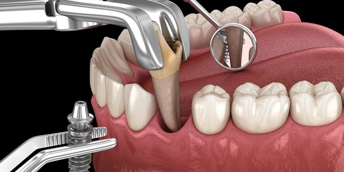How Effective Is Tooth Removal in Dubai for Pain Relief?