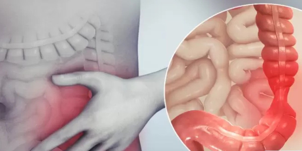 Pilonidal Sinus vs Fistula in IBD Patients: Key Differences