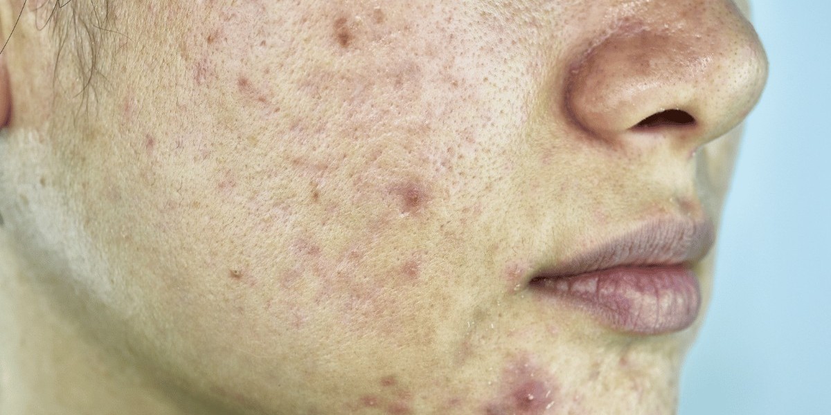 Can Glycolic Acid Peels Effectively Treat Acne Scars?