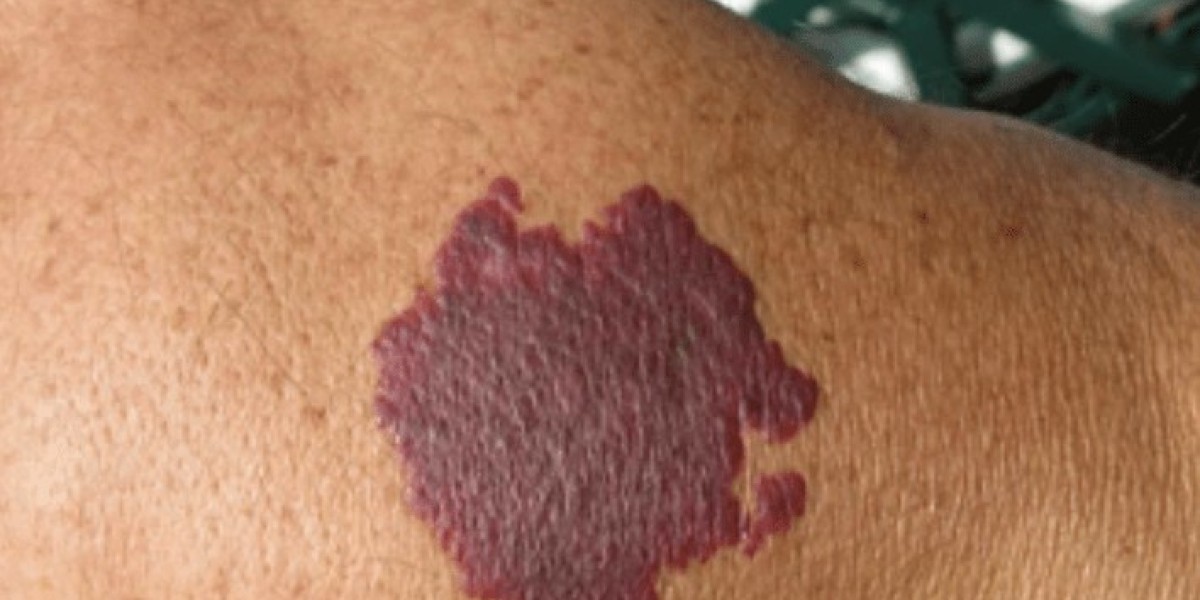 Can Port Wine Stain Lasers Work on Dark Skin?