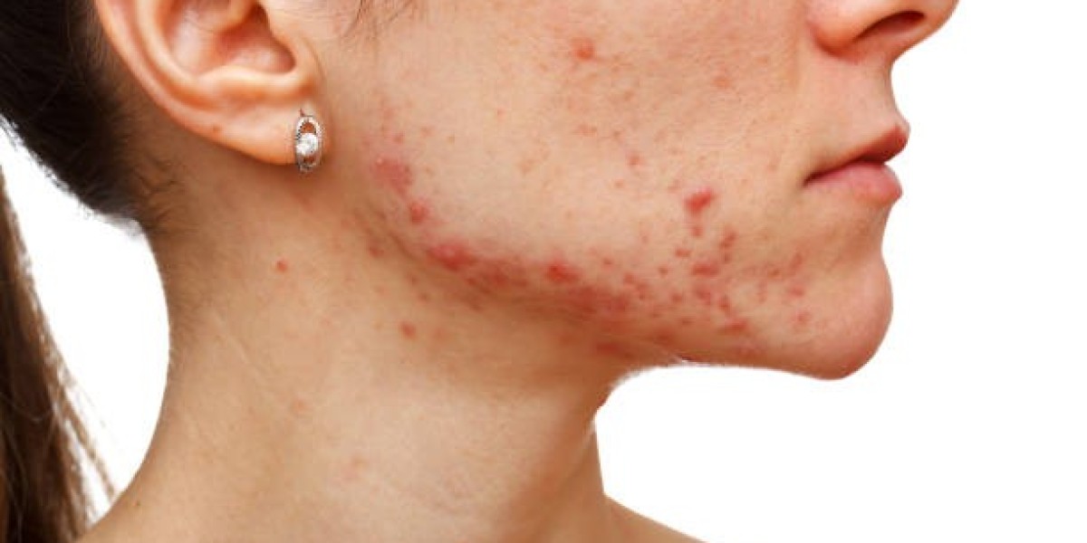 What Questions Should You Ask Your Dermatologist About Laser Acne Treatment?
