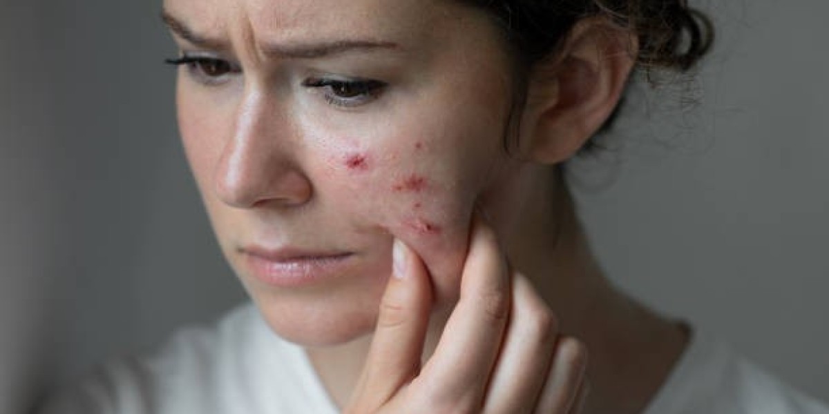 Proven Pimples Treatment Solutions for Sensitive Skin