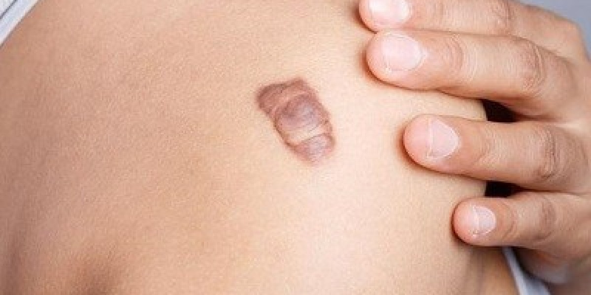 Unlock Effortless Skin Beauty With Scar Removal Dubai