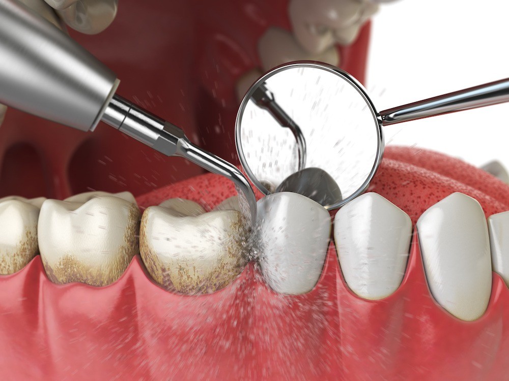 Teeth Cleaning in Dubai
