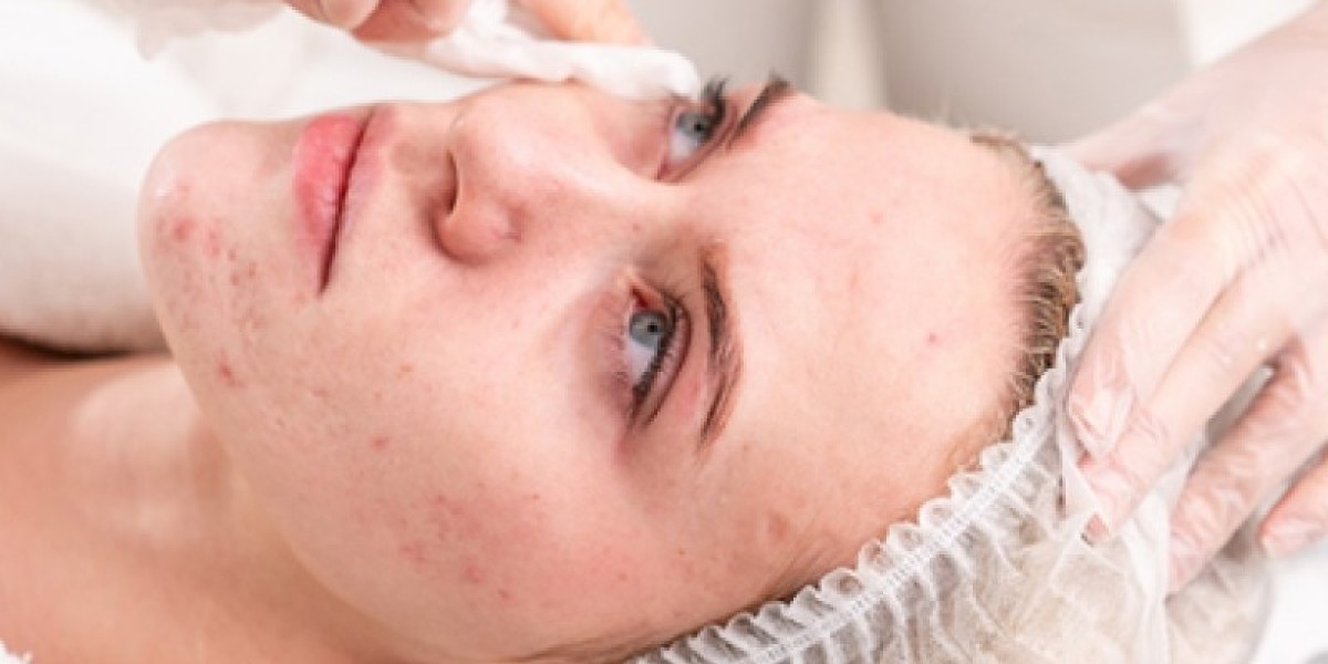 Acne Treatment Advice to Reduce Breakouts Quickly