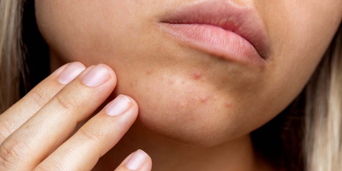 Which Pimples Treatment Targets Chin Acne Specifically?