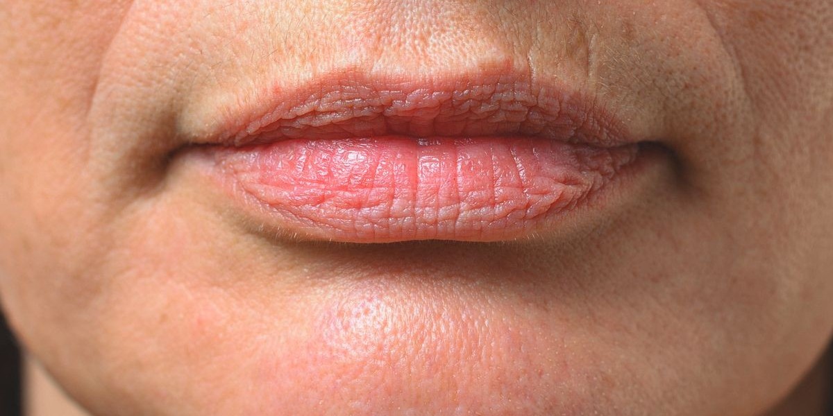 What Causes Smoker’s Lips and How Do Treatments Correct Them?