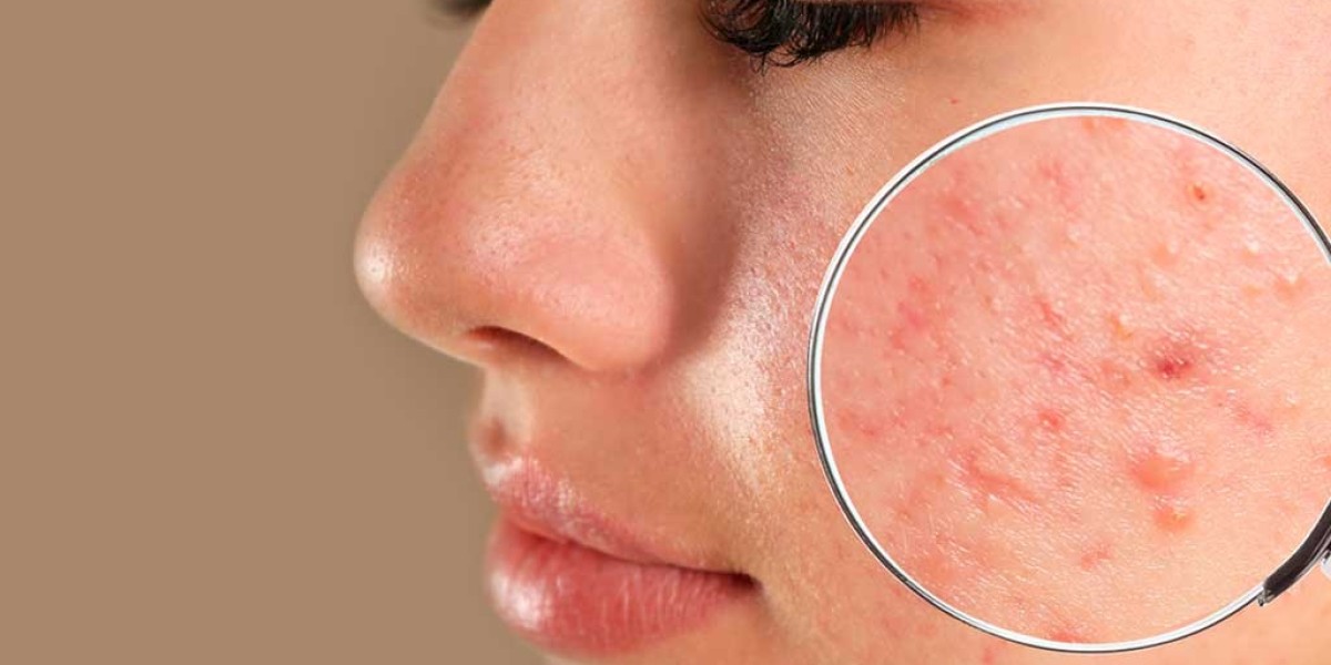 Pimple Treatment in Dubai: How to Manage Sensitive Skin