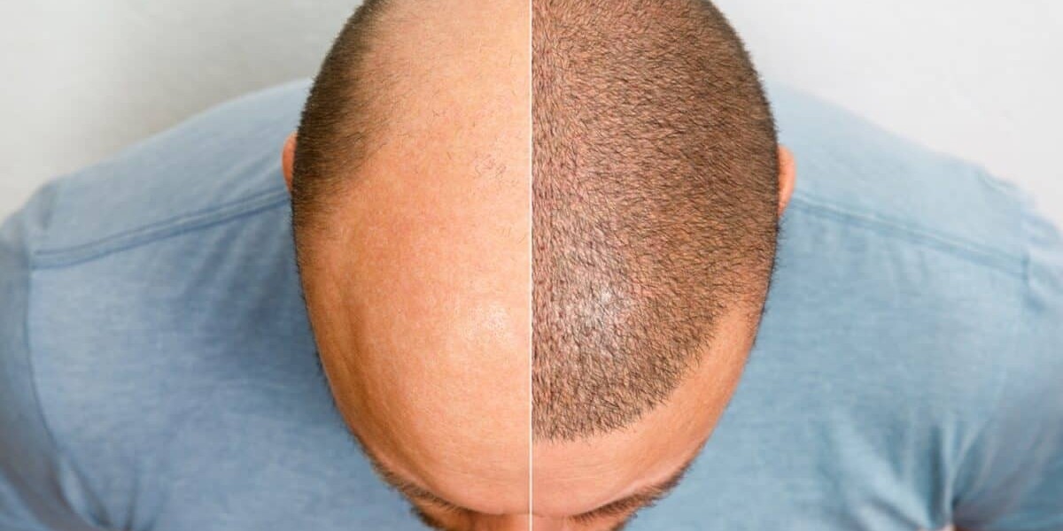 Affordable PRP Hair Treatment Riyadh Deals Offers
