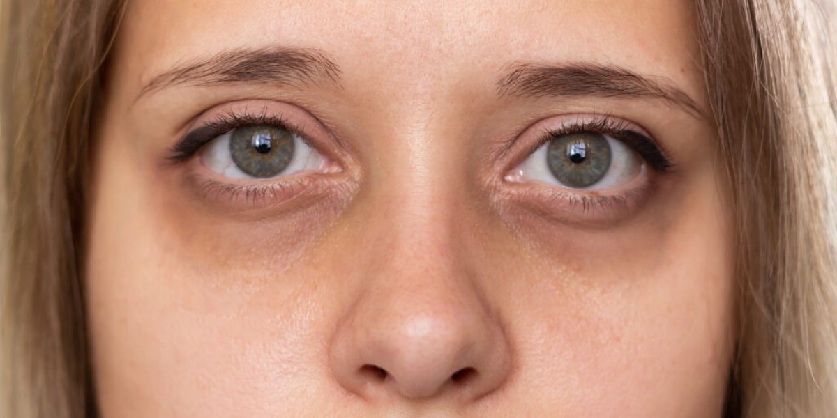 Can a Dermatologist Treat Dark Circles?