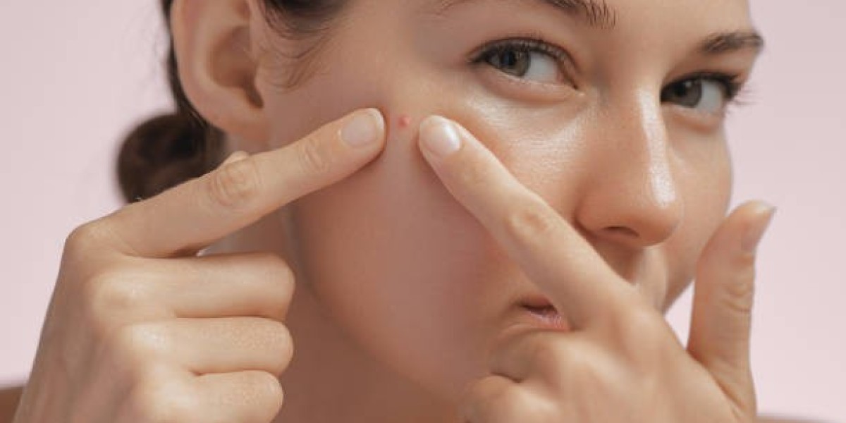 How to Improve Your Skin with Consistent Pimples Treatment