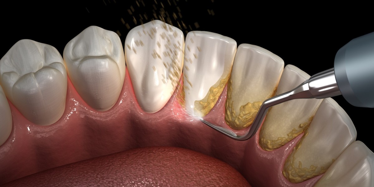 Can Teeth Cleaning in Dubai Remove Deep Stains?