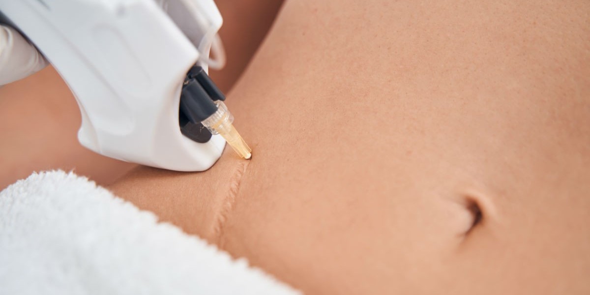 Scar Removal Dubai That Makes Skin Look Clear and Youthful