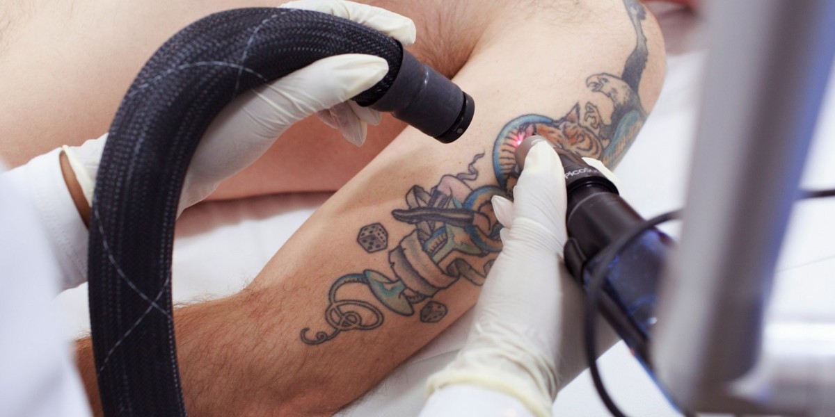What is the Safest Method for Tattoo Removal in Islamabad?