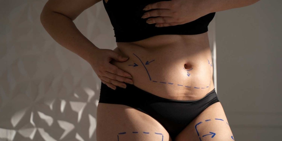 Incredible Bariatric Surgery in Islamabad
