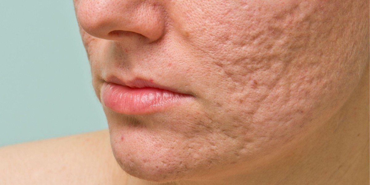Say Goodbye to Acne Scars with Treatments in Islamabad