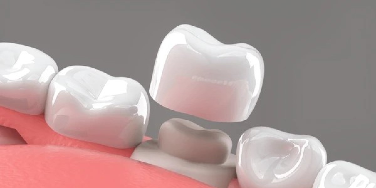 Fixing Cracked Teeth With Dental Crowns in Islamabad