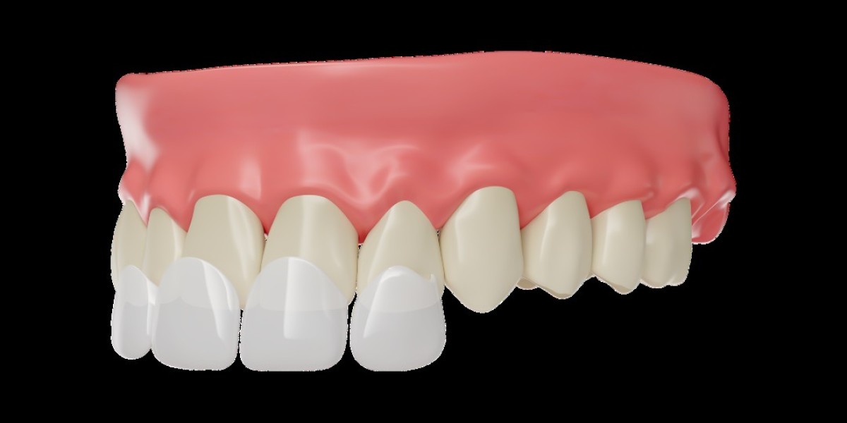 A Complete Guide to Composite Veneers in Perth: What You Need to Know