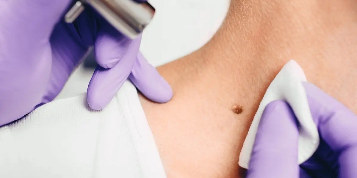 How Quick Is Skin Tag Removal in Dubai?