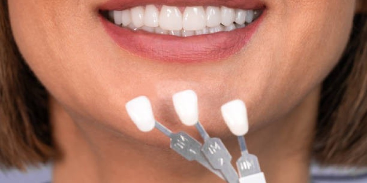 Enhance Your Smile with Advanced Dental Veneers in Islamabad