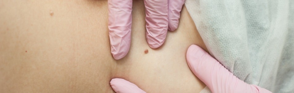 Skin Tag Removal in Dubai