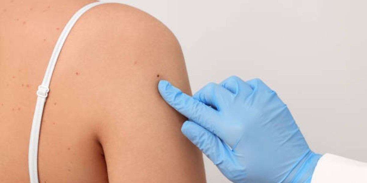 What Are the Most Common Myths About Skin Tag Removal?