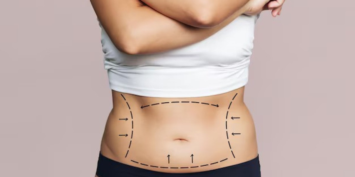 How Liposuction Works: Step-by-Step Procedure Explained