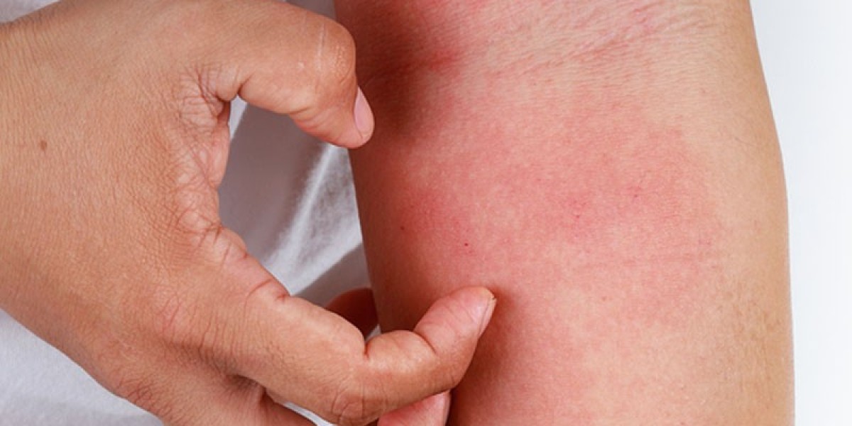 Nature Meets Innovation: A Patented Natural Solution for Chronic Fungal Skin Infections