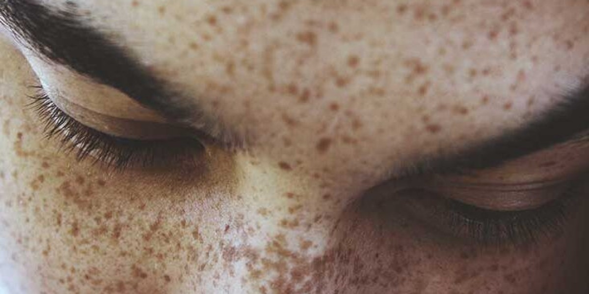 Can Freckles and Blemishes Be Treated on Sensitive Areas?