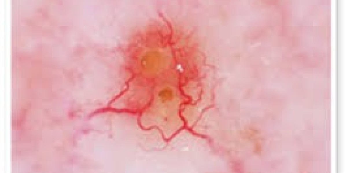Can Dermoscopy Detect Skin Cancer Early?