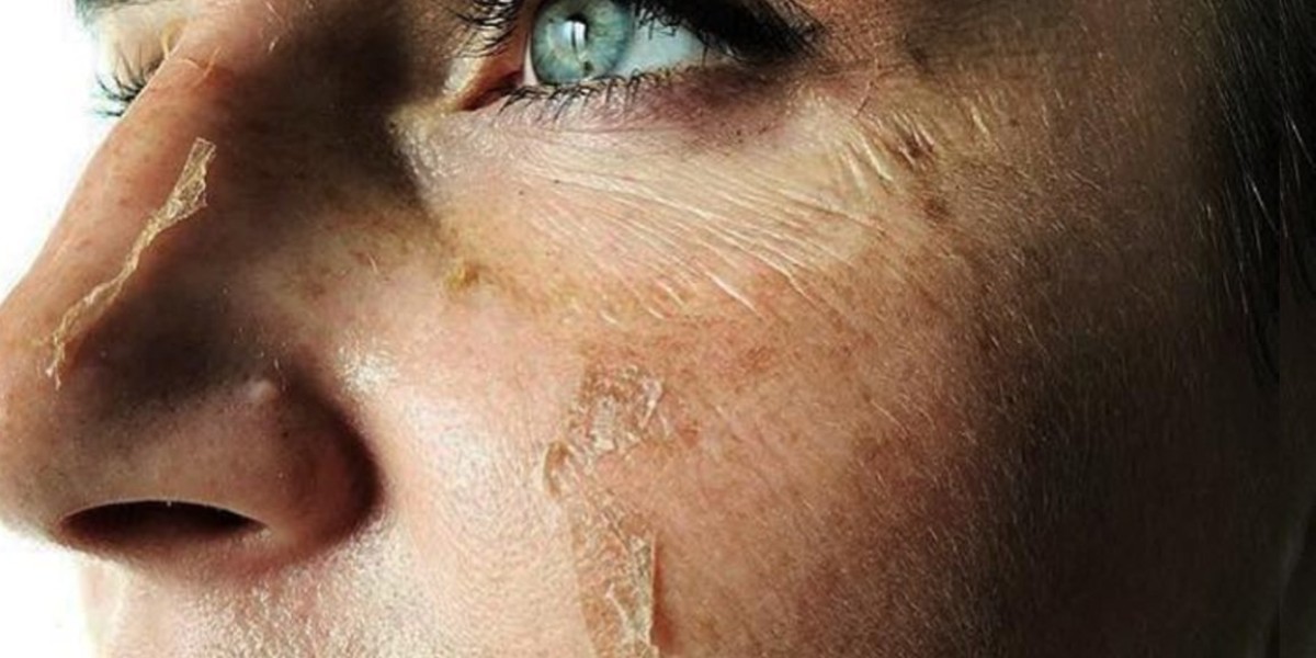 Cold Peel for Acne Scars: Does It Help?