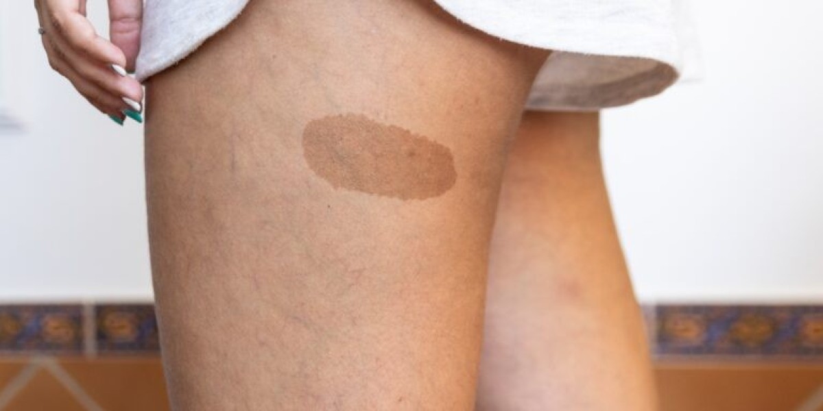 Does Birthmark Removal Work Well for All Skin Types?
