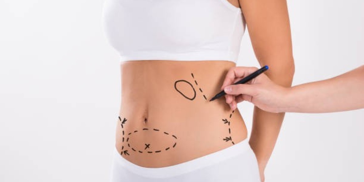 Liposuction Versus Other Fat Reduction Options in Riyadh