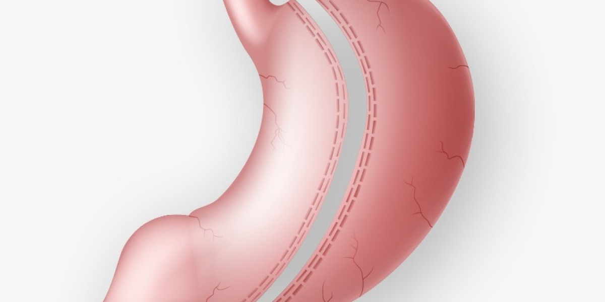 Is Gastric Sleeve Surgery Covered by Insurance?