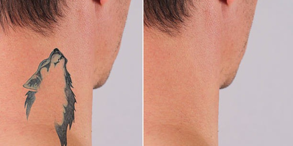 Key Benefits of Choosing Laser Tattoo Removal