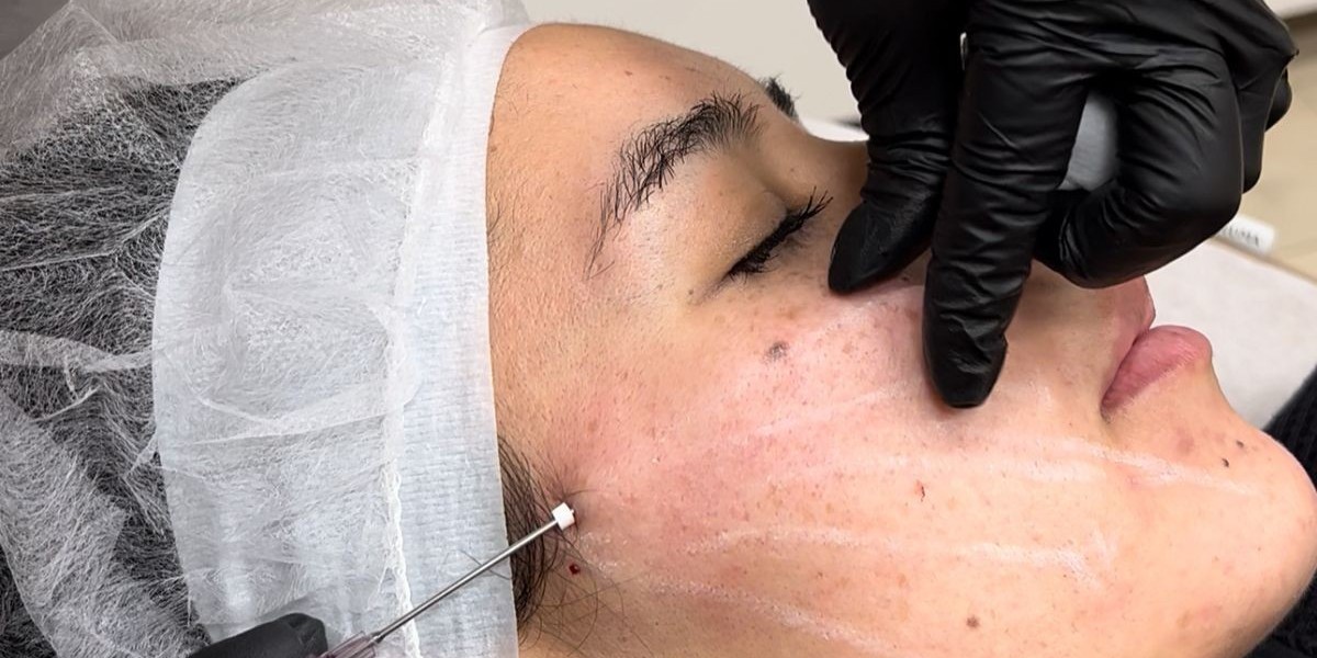 Is Sugar Thread Lift Safe for the Under-Eye Area?