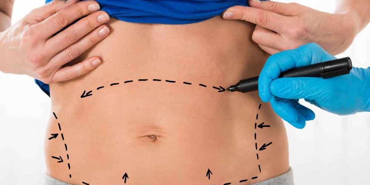Can a Tummy Tuck Remove Excess Belly Fat?