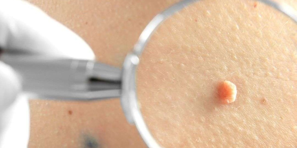 Is Mole Removal in Dubai Safe? What Experts Want You to Know