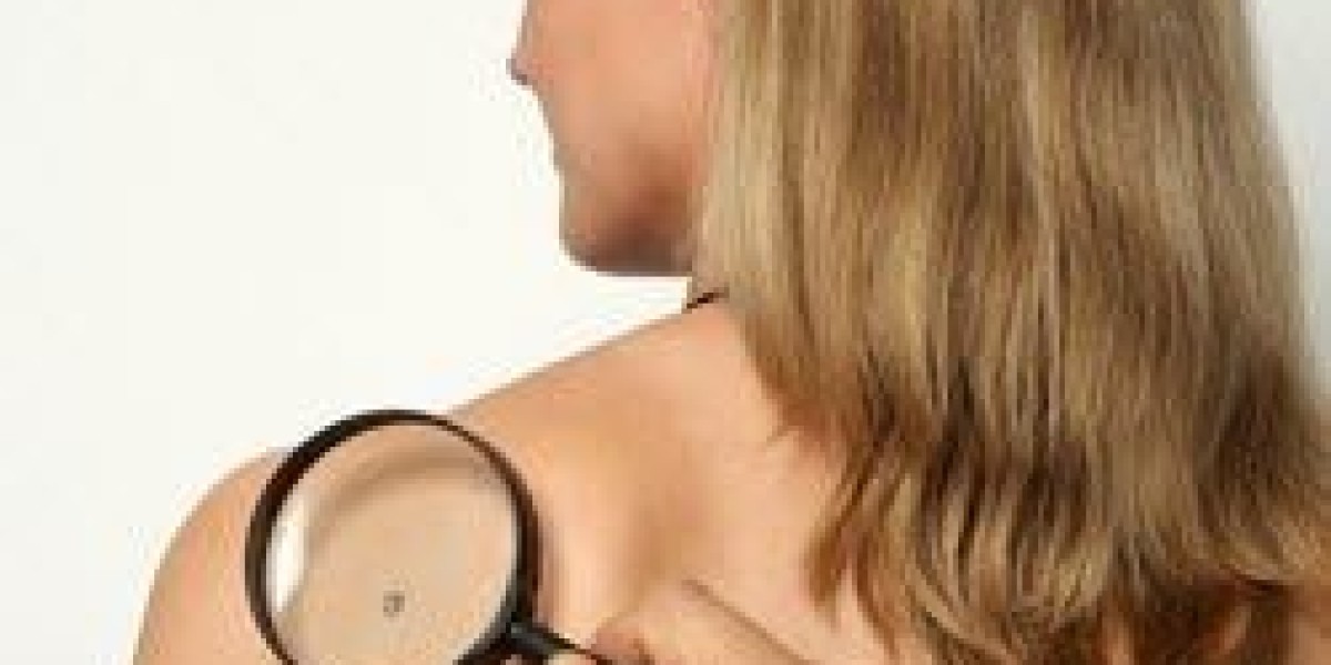 Mole Removal in Dubai: Before and After Results