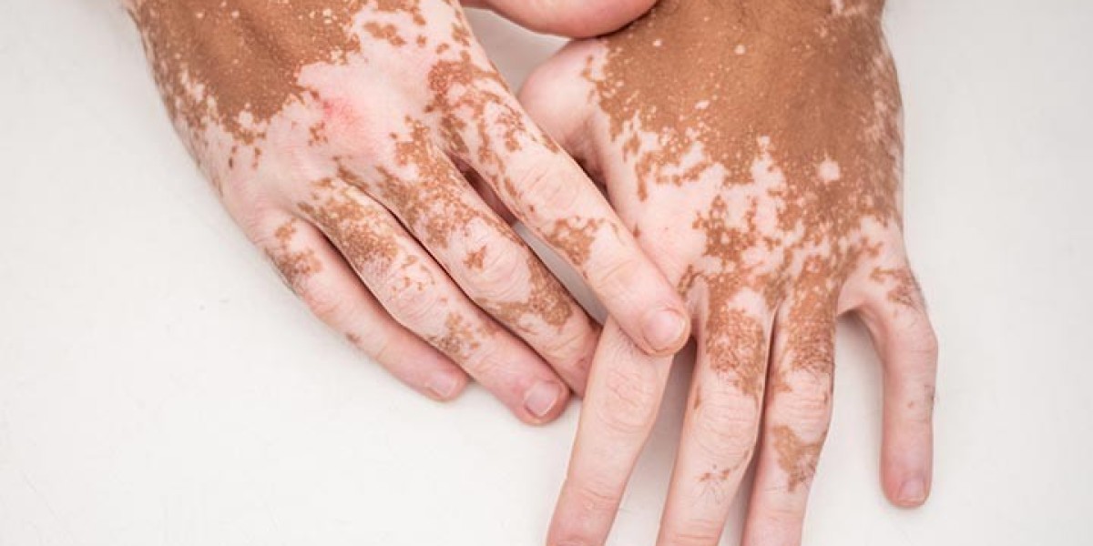 Does Camouflage Cover Vitiligo Patches?