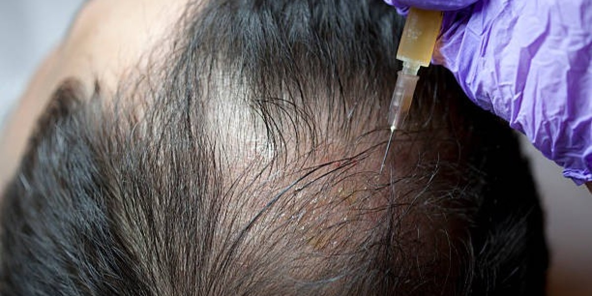 Top Plasma Injection Clinics for Hair in Dubai