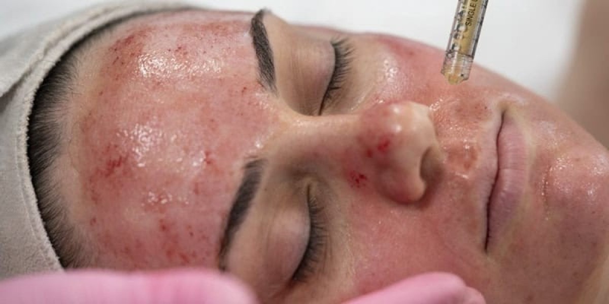How Does a Vampire Facial Work?