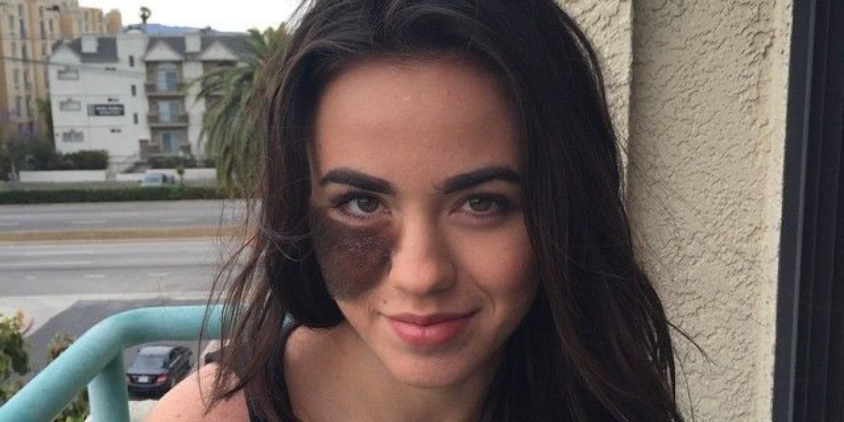 Birthmark Removal in Dubai: Which Treatment Is Right for Your Birthmark?