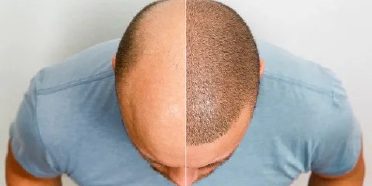 Hybrid Hair Transplant in Dubai: Correct Patchy Bald Spots