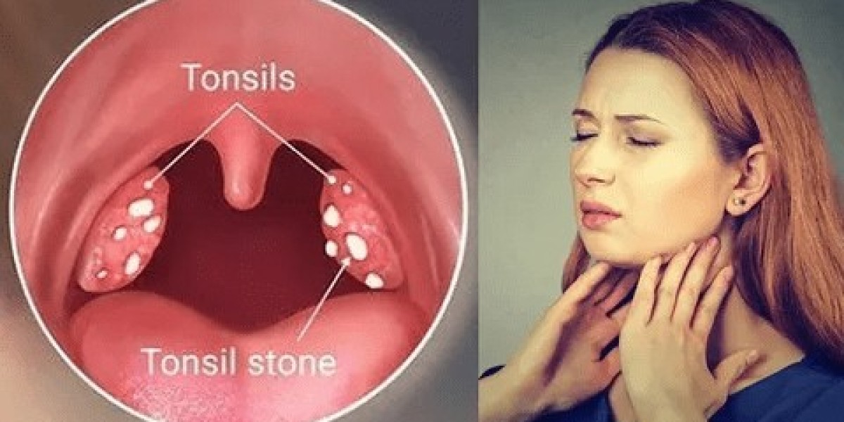 Tonsillitis Treatment Drugs Market Growth Driven by Pediatric Infections