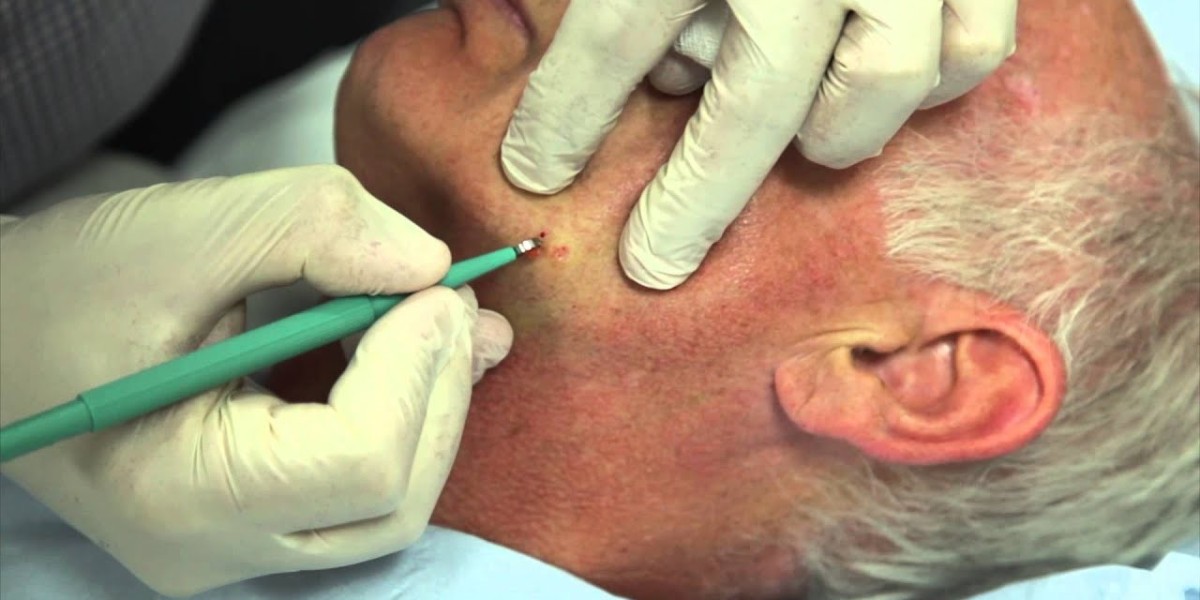 Skin Wart Removal Cost: Understanding Professional Fees