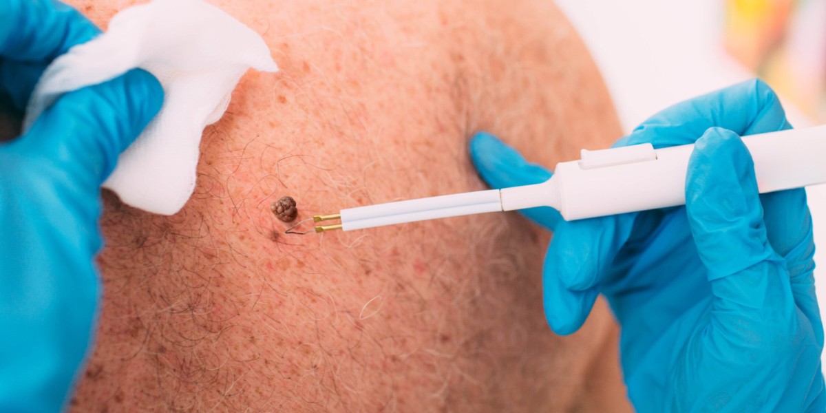 Is Skin Tag Removal Painful?