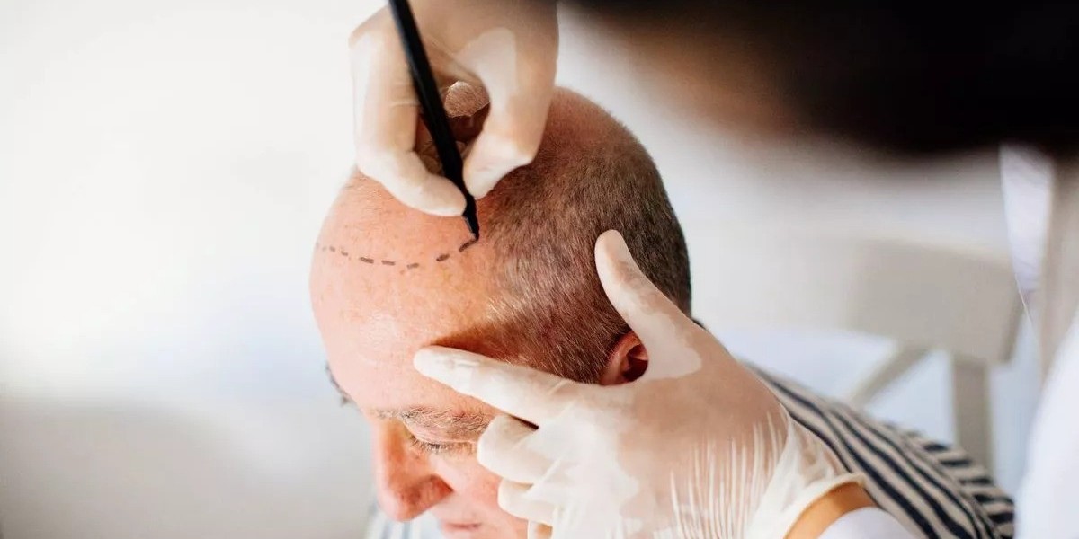 Recovery Timeline After Scarless Hair Transplant in Dubai