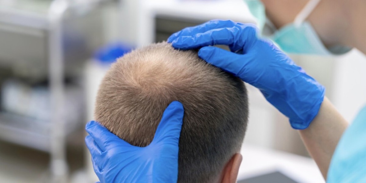 Shave vs Non-Shave Hair Transplant Pros Cons and Results