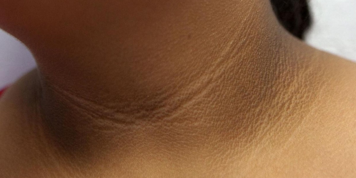 What Causes Dark Neck and How Can It Be Treated?